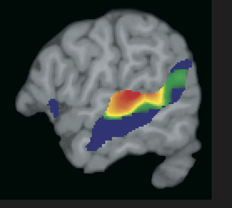 A view of the left hemisphere of the brain showing areas involved in spoken language comprehension (Matt Davis)